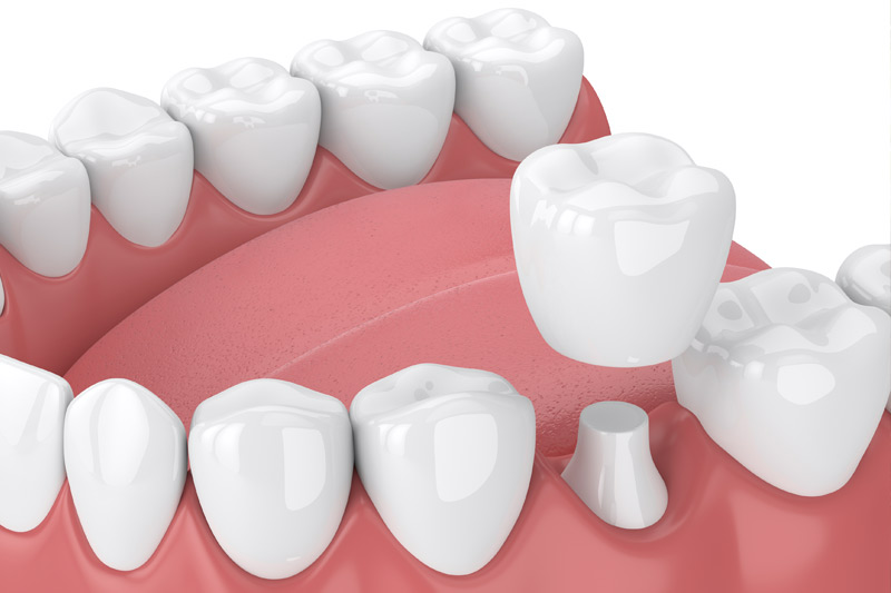 Dental Crowns in Fort Wayne
