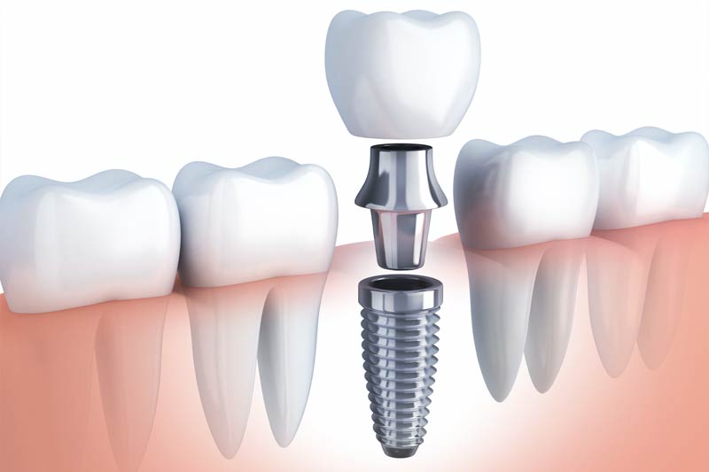 Dentist in Fort Wayne