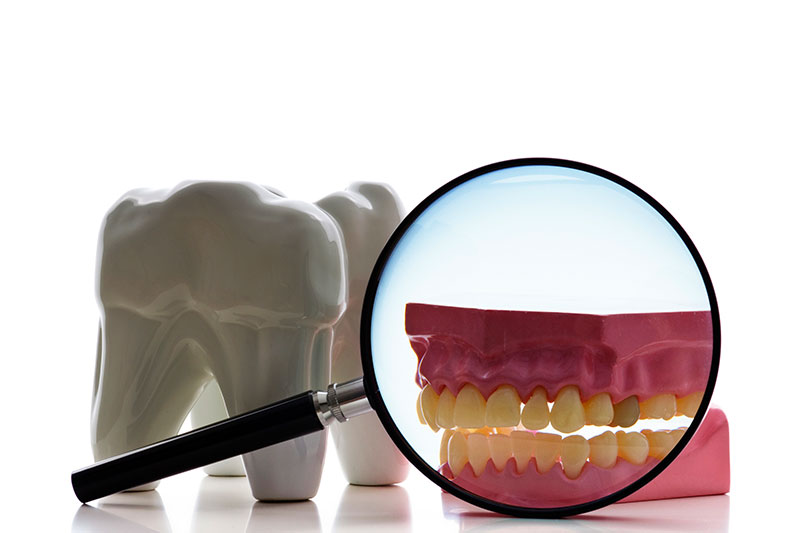 Root Canal in Fort Wayne