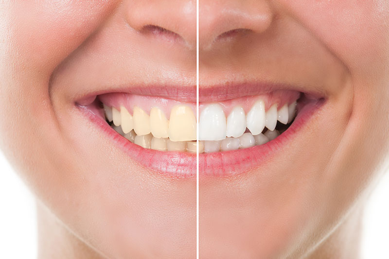 Teeth Whitening in Fort Wayne