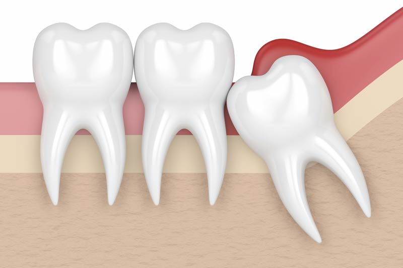 Wisdom Tooth Removal in Fort Wayne